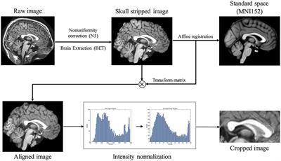 Automatic Segmentation of Corpus Callosum in Midsagittal Based on Bayesian Inference Consisting of Sparse Representation Error and Multi-Atlas Voting